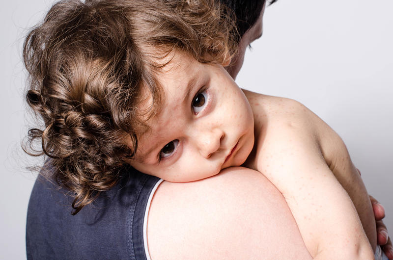 Numărul mic de vaccinări favorizează epidemilor de rujeolă, Foto: © Luanateutzi | Dreamstime.com